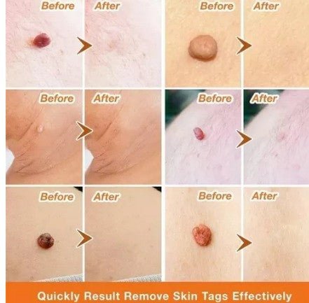 2X1/ FormuClear™ - Elimina verrugas sin dolor y seguro + ENVIO GRATIS - MERKATODOSV