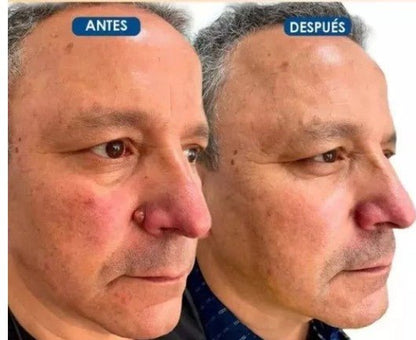 2X1/ FormuClear™ - Elimina verrugas sin dolor y seguro + ENVIO GRATIS - MERKATODOSV