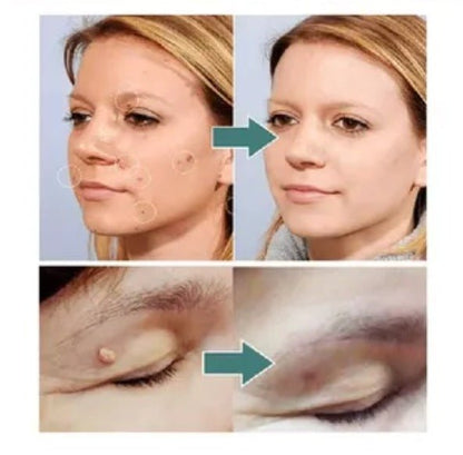 2X1/ FormuClear™ - Elimina verrugas sin dolor y seguro + ENVIO GRATIS - MERKATODOSV