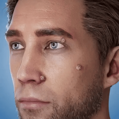 2X1/ FormuClear™ - Elimina verrugas sin dolor y seguro + ENVIO GRATIS