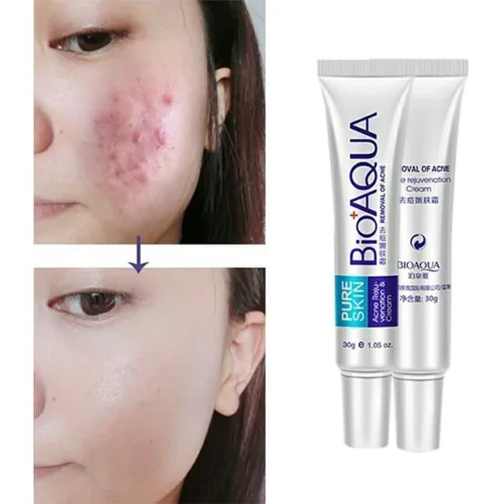 Crema Antiacné Bioaqua – Elimina Granos y Cicatrices - MERKATODOSV