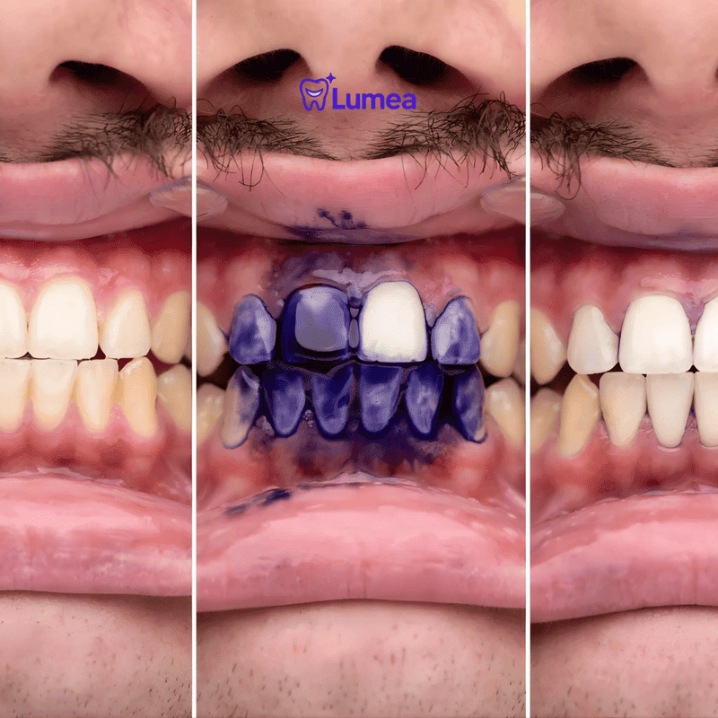 Purple Toothpaste Gel V34 | El Abrillantador Dental Nº1 - MERKATODOSV